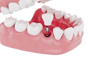 A model of a dental implant is shown on a white background.