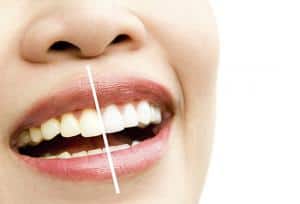 A woman's teeth before and after teeth whitening.
