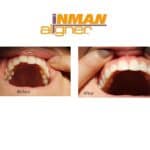 Straightening of the front upper teeth