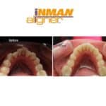 Straightening of lower teeth.