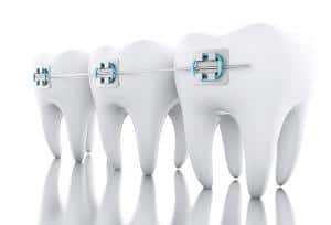 Three teeth with braces on a white background.