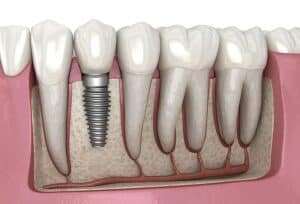 A tooth with a dental implant in it.