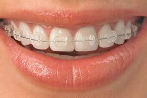 A woman smiles with clear braces on her teeth.