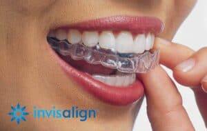Invisalign braces in san diego california.