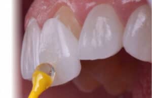 A close up of a tooth with a yellow liquid on it.