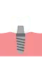 implants-2