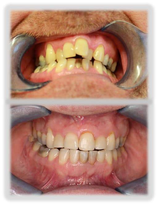 Before and after dental treatment, showcasing teeth cleaning and alignment.