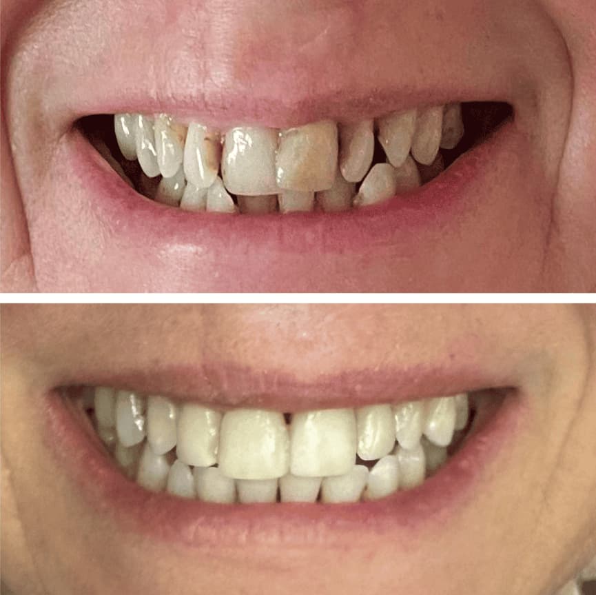 Two close-up photos of a person's smile: the top shows discolored and misaligned teeth, the bottom shows whiter, straighter teeth after dental treatment.