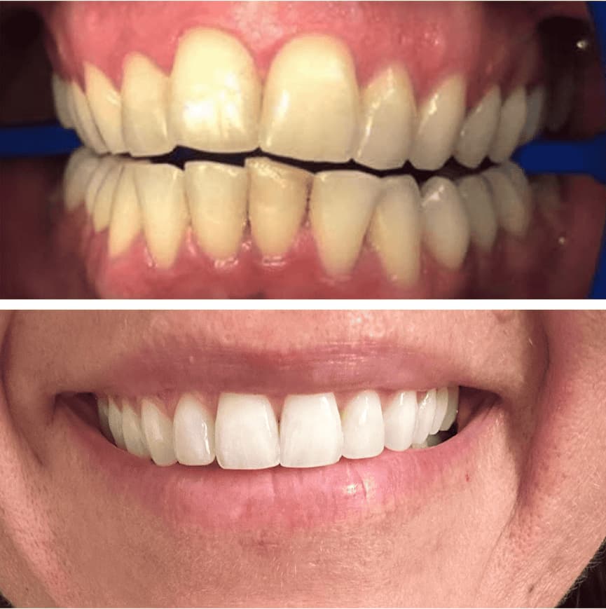 A before-and-after comparison of teeth, showing yellowed, uneven teeth on top and whiter, straighter teeth on the bottom.